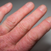 What should you do if you have risk factors or mild symptoms?