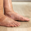 Swelling, heaviness, and tired legs